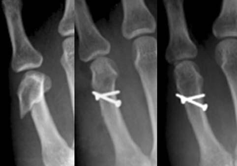 Fig. 2. Preoperative radiograph shows malunited 5 th metacarpal neck fracture at 7 weeks after initial trauma. Dorsal angulation was 54.