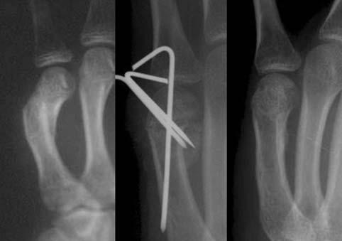 Preoperative radiograph shows angulation of 5 th metacarpal neck by reduction loss at 1 weeks after initial trauma.