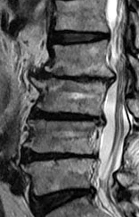 Number of Patients with Preoperative Radiological Degeneration in Each Group Number of patients Preop. degeneration Fig.. Preoperative radiographs of the lumbar spine.