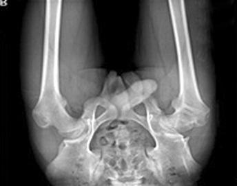 31 The Effect of Screw Apophysiodesis of Greater Trochanter in LCP Disease A B C D E Figure 1. Radiographs of a 7-year-old boy with unilateral Legg-Calve-Perthes disease.