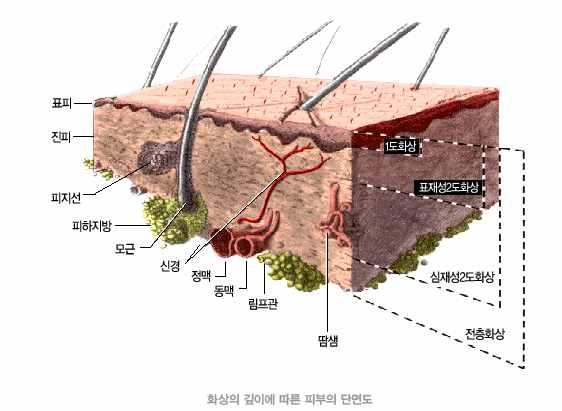 접촉화상저온화상화학화상증기화상마찰화상 난로 / 온열 기, 구이용석 쇠, 다리미, 뜨거운주방용 품등뜨거운 물체에 직접 접촉하여생기 는화상 접촉화상의 일종으로비교 적낮은온도 ( 4 0 ~ 5 0 ) 에 장시간 피부 접촉으로발생 하는 화상 ( 전 기장판, 핫팩, 뜸, 온열찜질, 모바일 베터리등 ) 기기 강산성, 강 알칼리성 및 기타화학물질 에의한손상 압력밥솥,