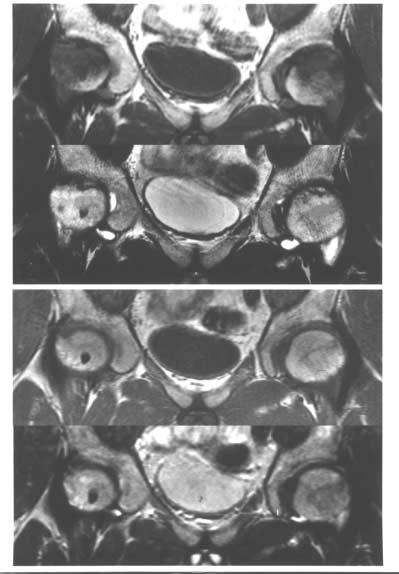 (A) AP and frogleg radiographs obtained three months after pain show that the right femoral head had collapsed. In the left femoral head, there is a radiolucent line (arrowhead).