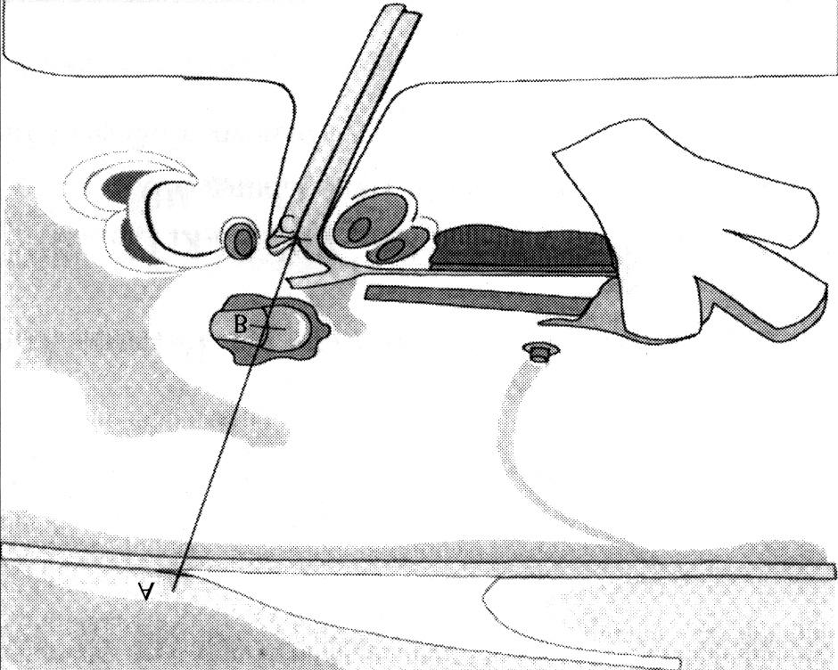 Landmarks of internal acoustic canal using external references. APosterior point. BMalleo-incudal joint. C Bill s bar. Fig. 3.