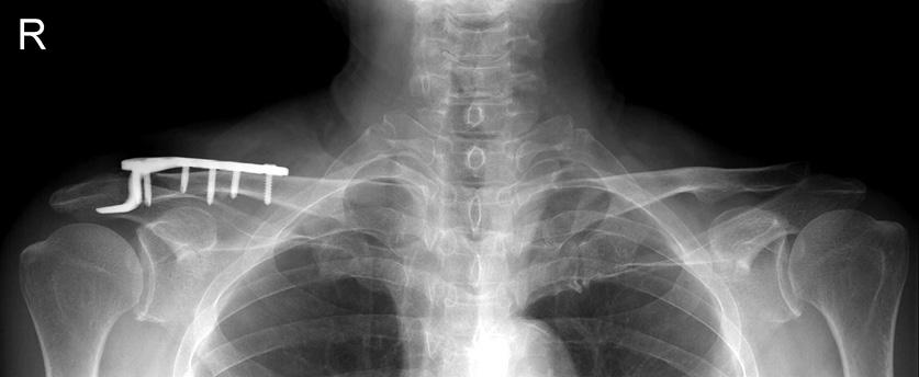 (A) Neer type IIA fracture of the distal clavicle in a 68-yearold man is seen.