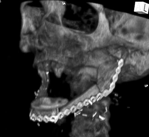 osteotomy for 3 dimensional mandibular reconstruction) 은비교적최근에이르러서야활발히사용되기시작했으며, Hirsch 등 [2]