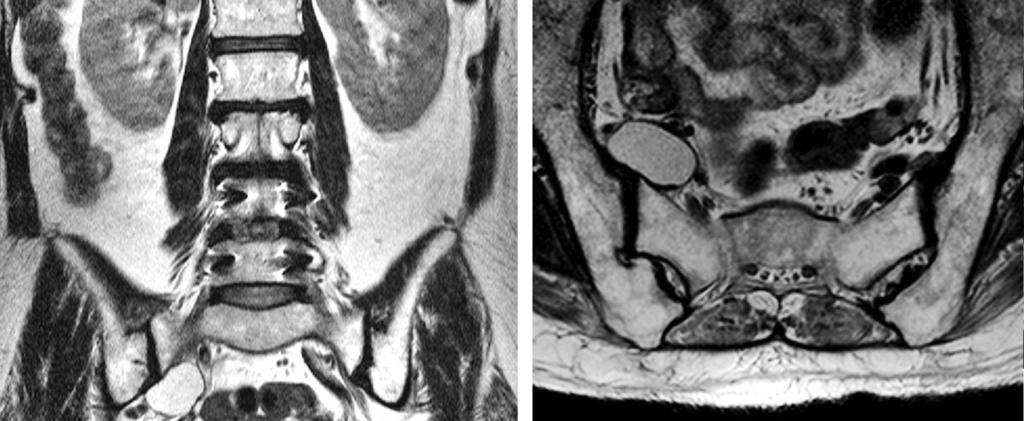 Ji-Eun Kwon et al Volume 22 Number 4 December 2015 A B Fig. 3. Follow-up MRI revealed the increased size of the cystic lesion measuring 3.3 cm 2.2 cm 1.