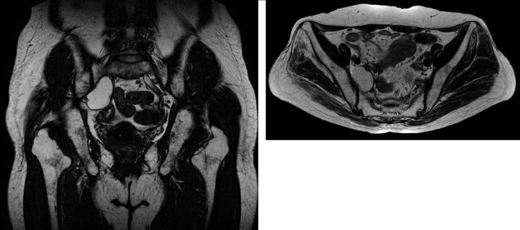 Follow-up MRI taken after three years of the operation showed a further increase in the lesion size to 4.9 cm 2.6 cm 1.8 cm in the coronal (A) and axial (B) images. 다.