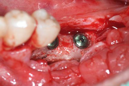 implant surgical procedure (A)