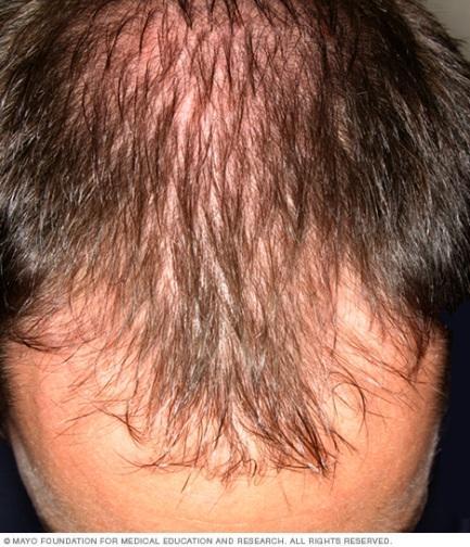 Androgenetic alopecia: