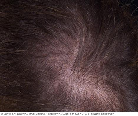 baldness Female-pattern