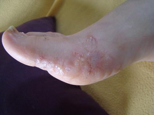 족부백선 1) 지간형 : 발가락사이, 특히네번째, 또는세번째발가락사이생김발가락사이가균열되거나,