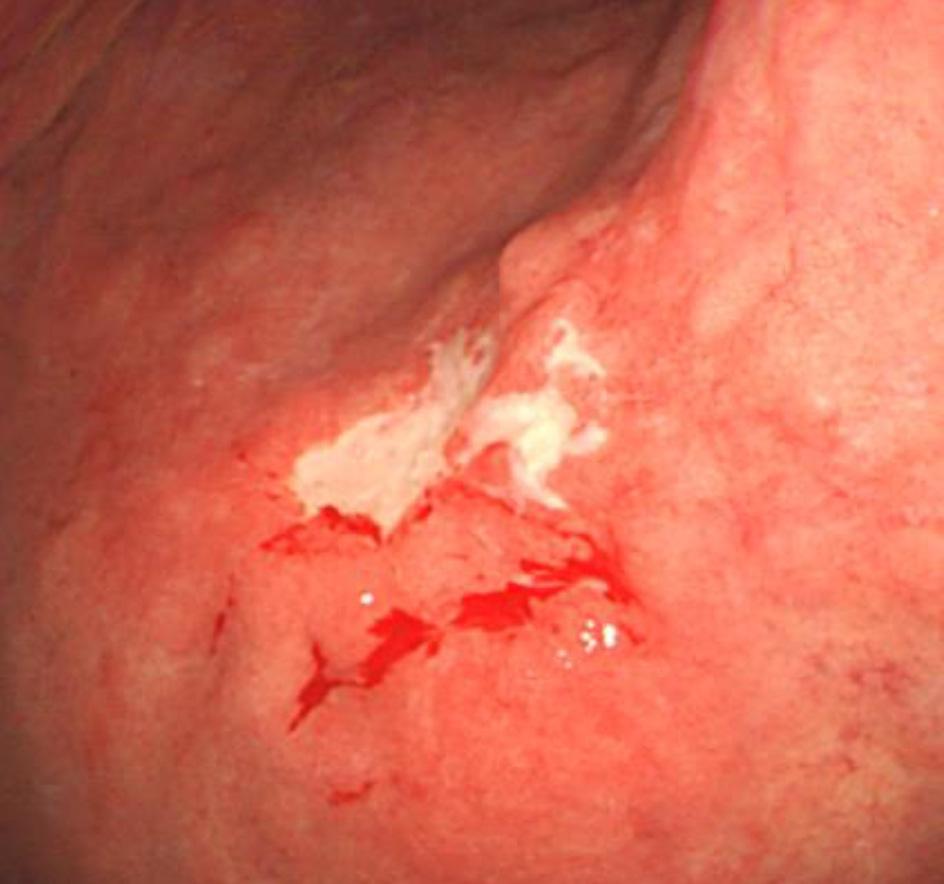 Endoscopic findings of EpsteinBarr virus-associated gastric carcinoma.