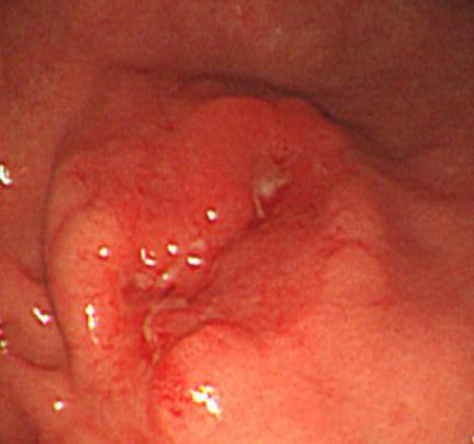 (C) Submucosal tumor-like morphology on the posterior wall of the