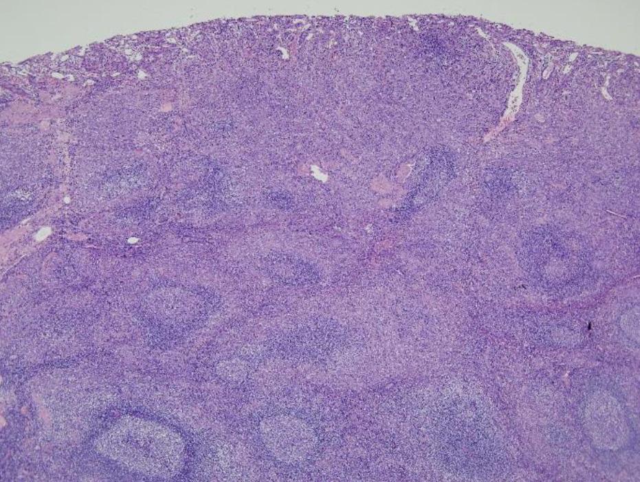 (D) Marked gastric wall thickening with ulceration on the greater