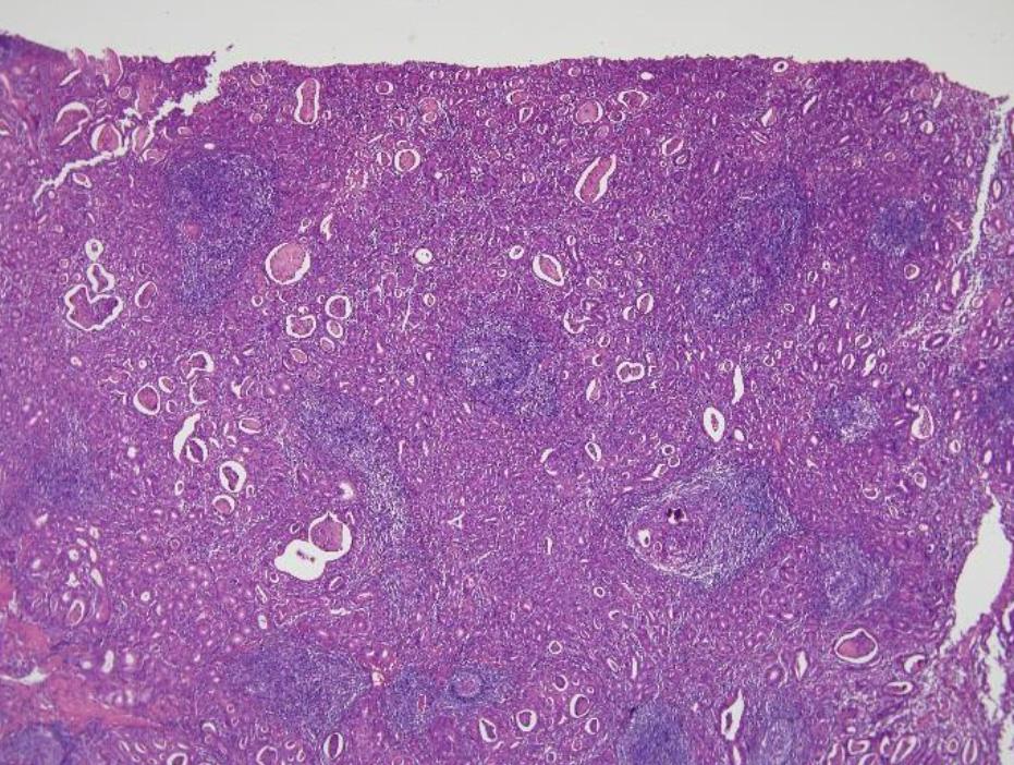 Histologic findings of EpsteinBarr virus-associated gastric carcinoma