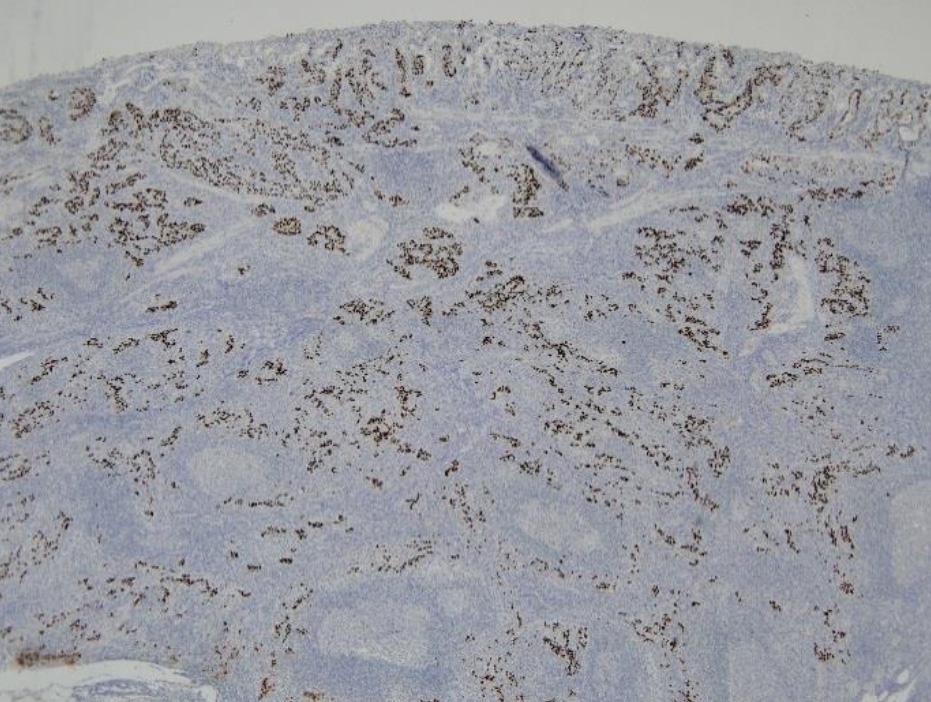 (A) Typical lymphoepithelioma-like carcinoma shows dense lymphocytic
