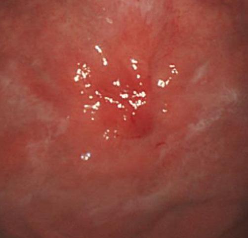 Bong Eun Lee: Epstein-Barr Virus-associated Gastric Carcinoma 또는궤양형 (ulcerative) 이흔하며, 많은경우에서위벽비후가두드러지면서점막하종양유사위암 (submucosal