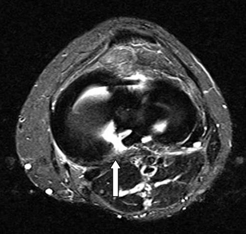 CH Lee, et al. Minimum 1 Year Results of Arthroscopic Pull-out Repair for Posterior Root Tear of Medial Meniscus (circumferential tension) 에의해유지된다 2).