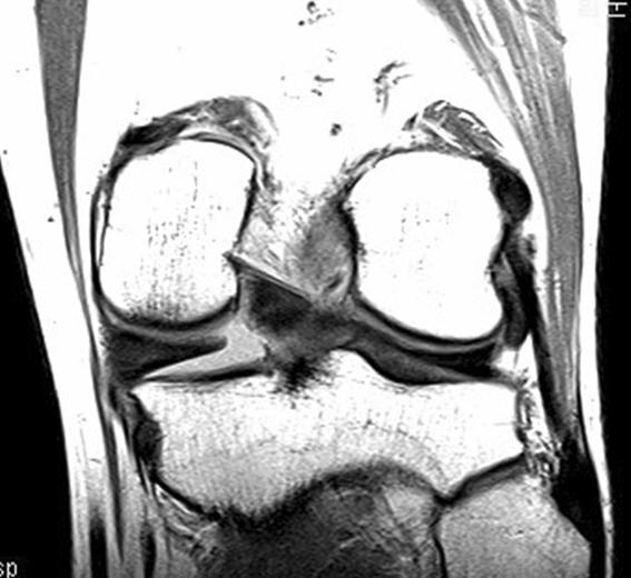 연구방법 2006년 10월부터 2009년 5월까지술전자기공명영상 (magnetic resonance imaging, MRI) 및이학적소견상내측반월상연골판의파열로진단받고관절경적수술을시행받은 289명, 317 슬관절중 63명, 63 슬관절 (19.9%) 이내측반월상연골판후방골기시부파열로관절경적수술을시행받았다.