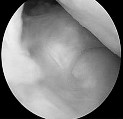 CH Lee, et al. Minimum 1 Year Results of Arthroscopic Pull-out Repair for Posterior Root Tear of Medial Meniscus Fig. 5.