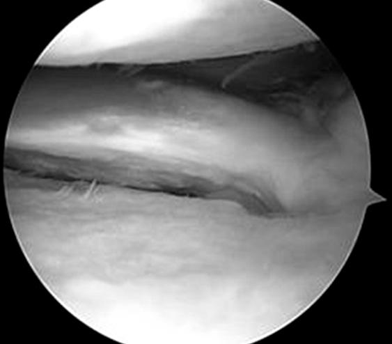 Postoperative 6-month second-look arthroscopy revealed tear site was healed and reattached to the foot print of posterior horn of medial meniscus. 시행하여내고정물제거술과함께봉합부의치유를확인하였다 (Fig. 6).