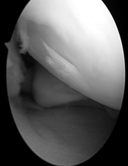 이철형 외. 내측 반월상 연골판 후방 골 기시부 파열의 관절경적 봉합술 후 최소 1년 추시 결과 Fig. 7.