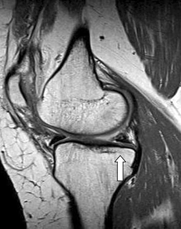 posterior root of medial meniscus in coronal section (black arrow) and sagittal section (white arrow).