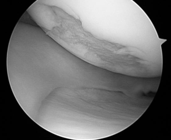 CH Lee, et al. Minimum 1 Year Results of Arthroscopic Pull-out Repair for Posterior Root Tear of Medial Meniscus Fig. 9.