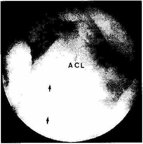 Infrapatellar plica is attached to the ACL.