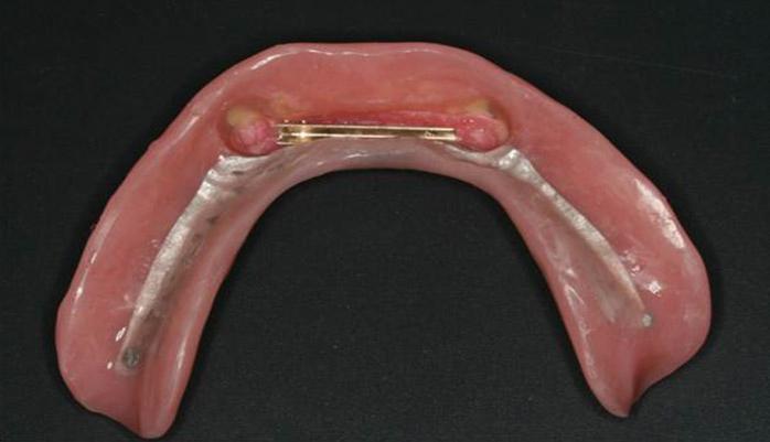 Final restoration was placed in patient's oral cavity.