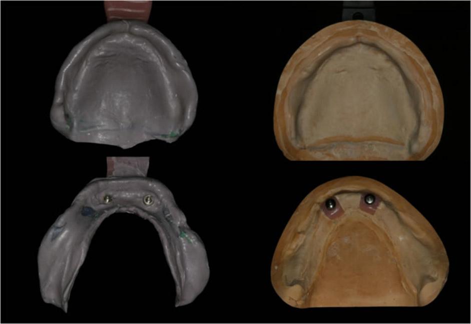Fig. 13. Final impression taking of maxilla and mandible with individual trays and corresponding definitive cast. Fig. 14. Tooth arrangement.