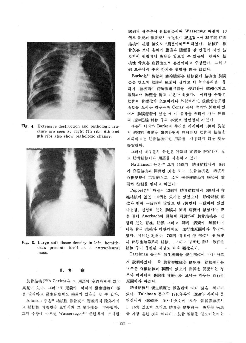 Fig. 4. Extensive destruction and pathologic fracture are seen at right 7th rib_ 6tí. <t l'ù 8th ribs also show pathologic change.