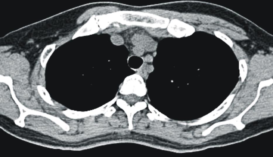 2), 초음파 검사에서 양측 흉골쇄골 관절의 관 절면이 불규칙한 비정상 소견을 보였다(Fig. 3).