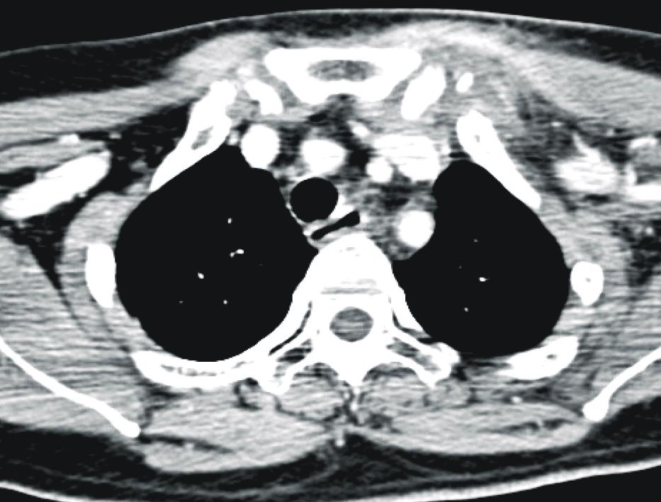 R: 1st rib, M: manubrium. S S A Fig. 6. Focal soft tissue bulging around Lt.