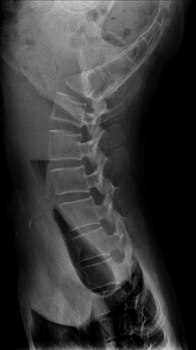 Lumbar spine sagittal fat suppression magnetic resonance imaging shows L1, 3, 5 vertebral body fractures. Table 1. Dual-Energy X-Ray Absorptiometry of Case No.