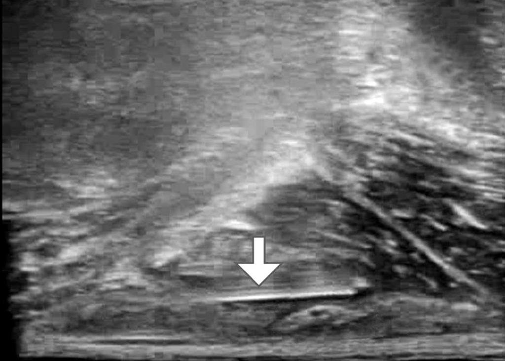 437 Ultrasound-Guided Regional Nerve Block in Below-Knee Amputation Table 1.
