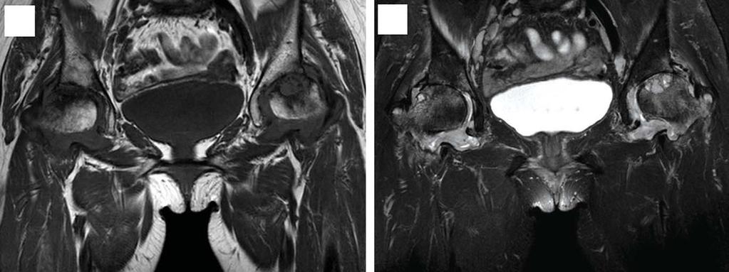 Cheol Hee Park et al.: Acute Phase of Sero-negative Rheumatoid Arthritis Misdiagnosed as Pyogenic Arthritis 연골하골의골흡수및낭종형성소견을관찰할수있었다 (Fig. 1).
