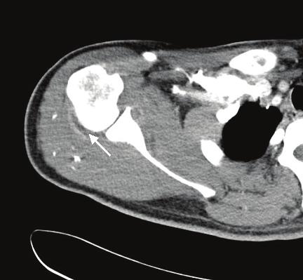 (B) Joint effusion was disappeared after antibiotic treatment. Fig. 3.