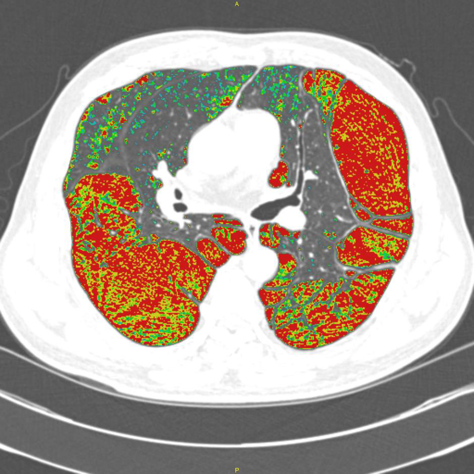 Figure 1. Quantitative analysis using inspiratory CT scan in 62-year-old male patient with COPD (FEV1/FVC % pred=51%, FEV1 % pred=52%).