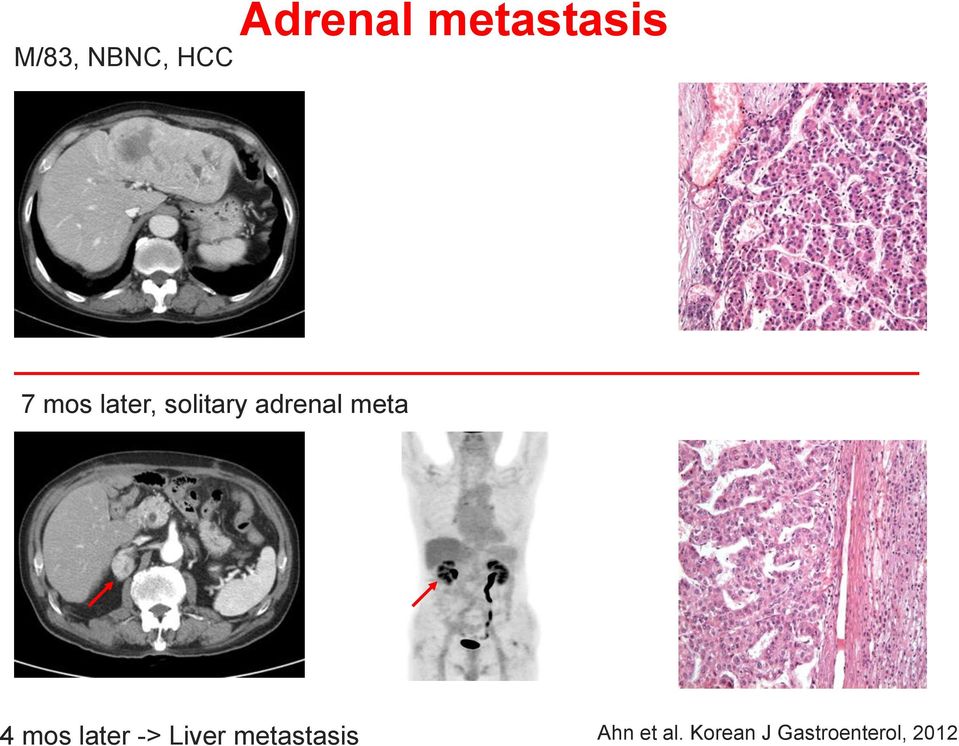 4 mos later -> Liver metastasis Ahn