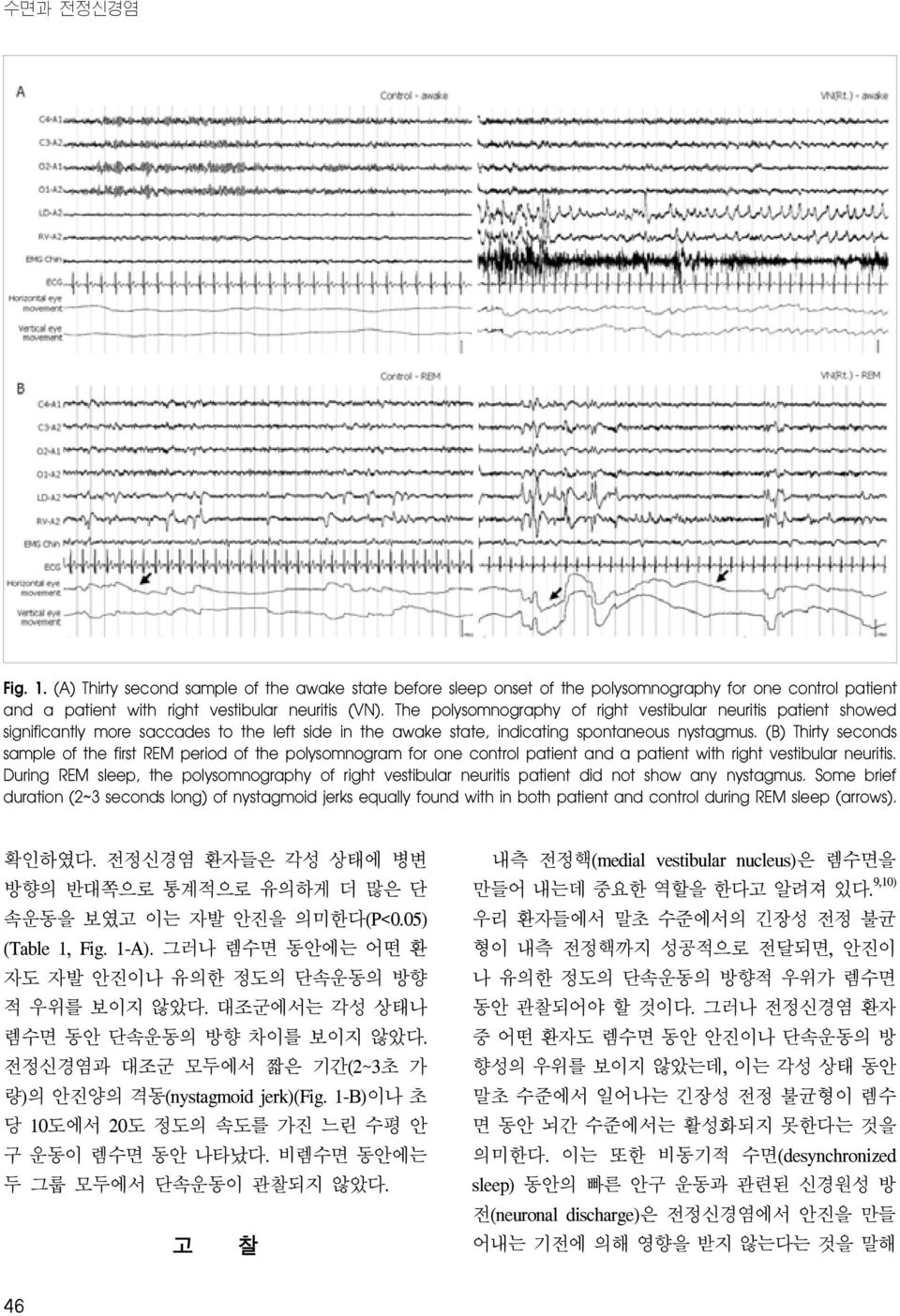 (B) Thirty seconds sample of the first REM period of the polysomnogram for one control patient and a patient with right vestibular neuritis.