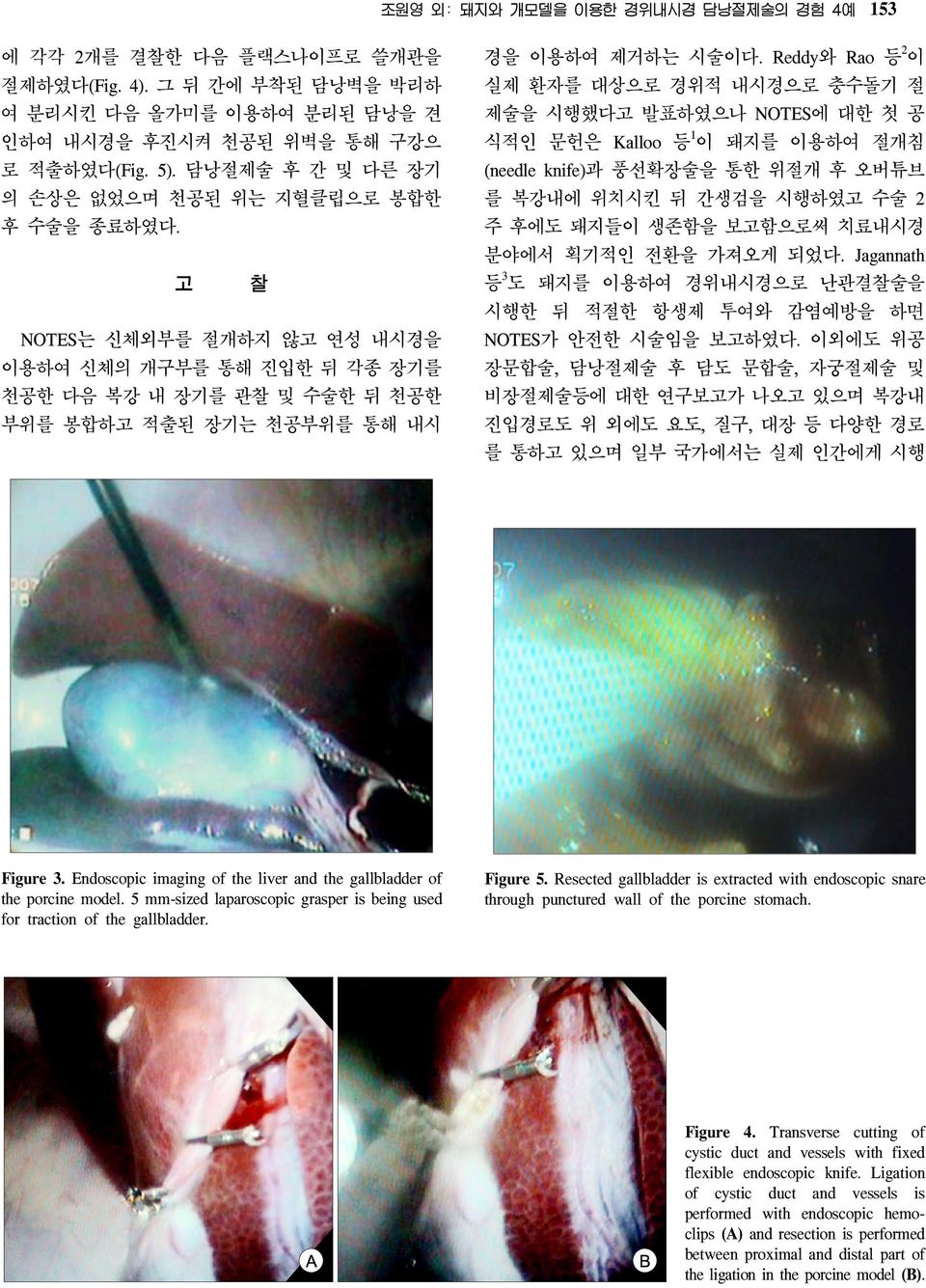 Endoscopic imaging of the liver and the gallbladder of the porcine model. 5 mm-sized laparoscopic grasper is being used for traction of the gallbladder. 153 2 경을 이용하여 제거하는 시술이다.