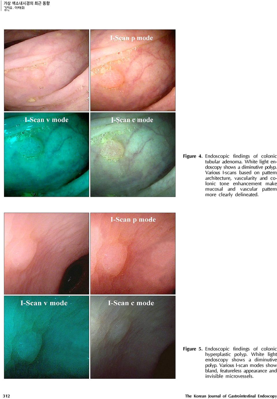 more clearly delineated. Figure 5. Endoscopic findings of colonic hyperplastic polyp.