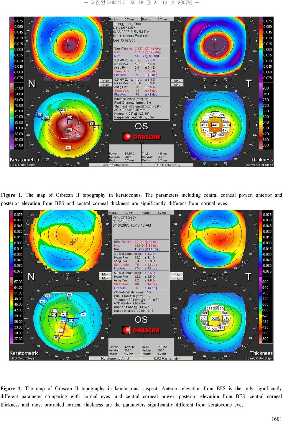 different from normal eyes. Figure 2. The map of Orbscan II topography in keratoconus suspect.