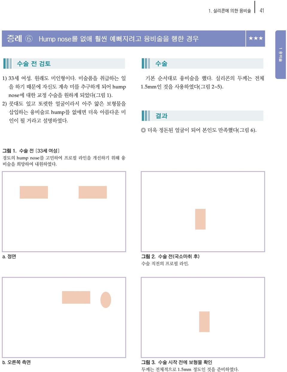 nose에 대한 교정 수술을 원하게 되었다(그림 1). 2) 콧대도 있고 또렷한 얼굴이라서 아주 얇은 보형물을 삽입하는 융비술로 hump를 없애면 더욱 아름다운 미 인이 될 거라고 설명하였다.