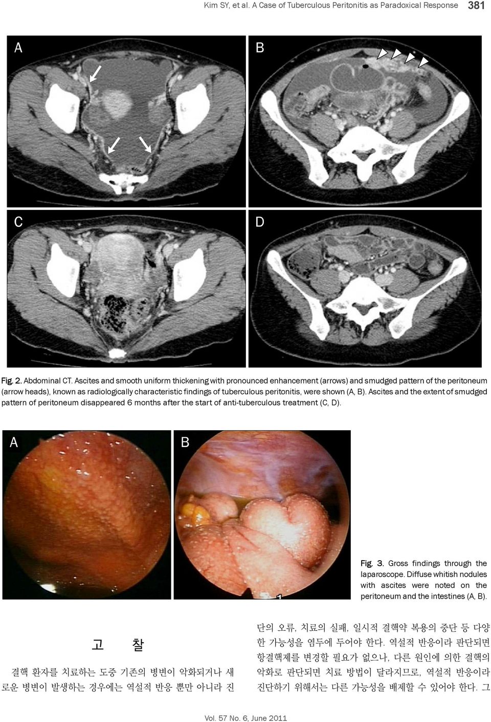 peritonitis, were shown (A, B). Ascites and the extent of smudged pattern of peritoneum disappeared 6 months after the start of anti-tuberculous treatment (C, D). Fig. 3.