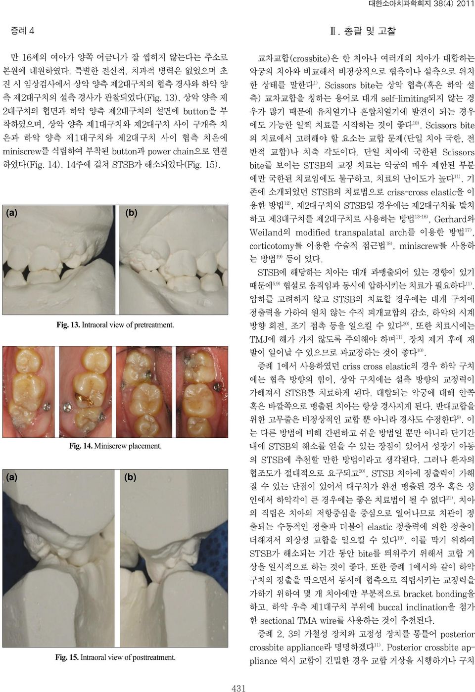 (a) (b) Fig. 13. Intraoral view of pretreatment. Fig. 14. Miniscrew placement. (a) (b) Fig. 15. Intraoral view of posttreatment.