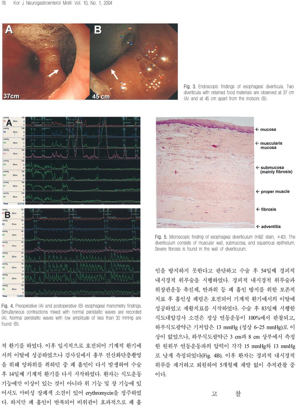 The diverticulum consists of muscular wall, submucosa, and squamous epithelium. Severe fibrosis is found in the wall of diverticulum. 인을 방지하지 못한다고 판단하고 수술 후 54일째 경피적 내시경적 위루술을 시행하였다.