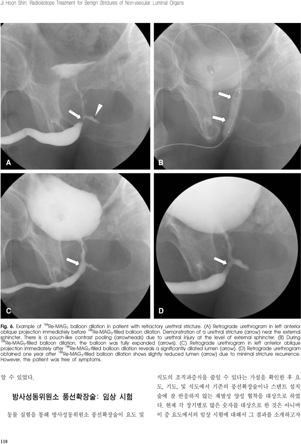 There is a pouch-like contrast pooling (arrowheads) due to urethral injury at the level of external sphincter. (B) During 188 Re-MAG 3-filled balloon dilation, the balloon was fully expanded (arrows).