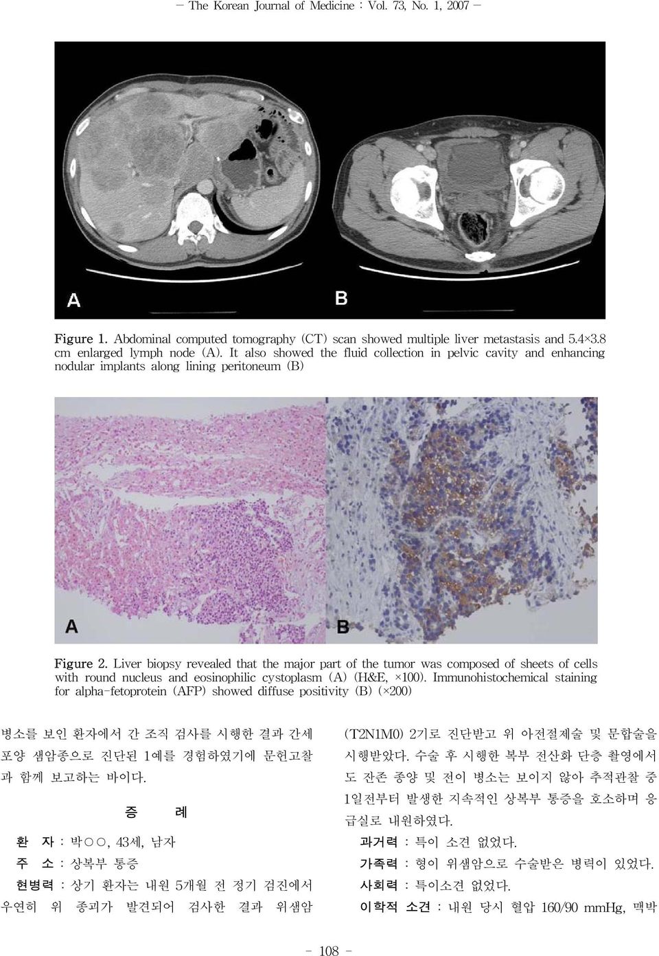 Liver biopsy revealed that the major part of the tumor was composed of sheets of cells with round nucleus and eosinophilic cystoplasm (A) (H&E, 100).